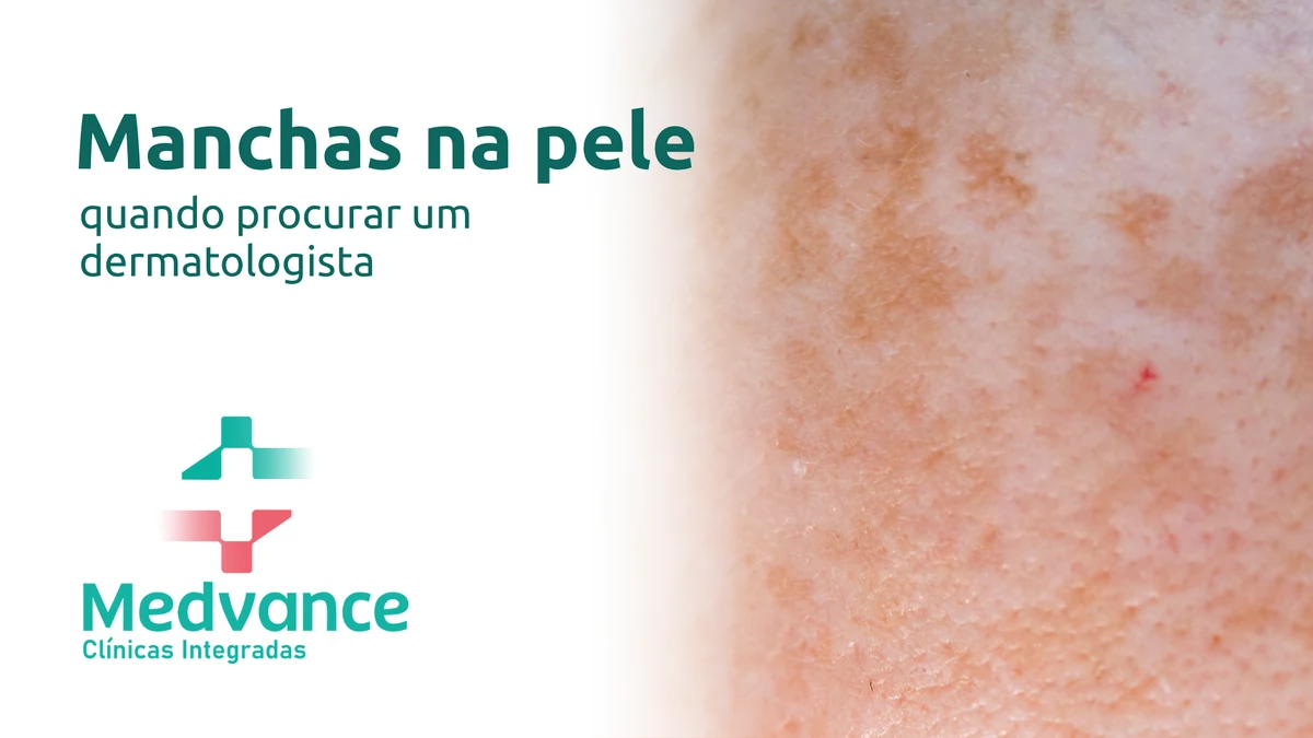 Capa Medvance sobre manchas na pele, com detalhe de manchas na pele.